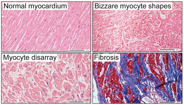 Histopathological features of HCM